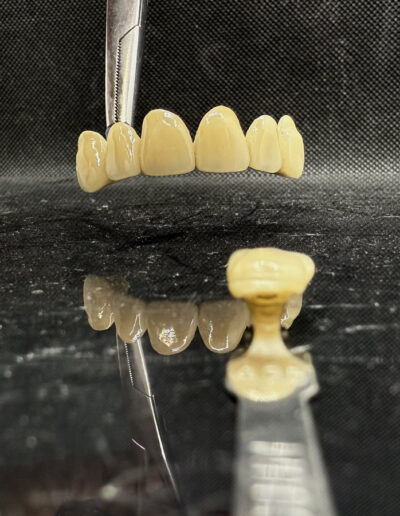 Fémkerámia híd, főkép